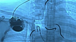 Fluoroscopy AICD (Automatic Implantable Cardioverter Defibrillator) and leads after implantation again due to left side lead is fracture.