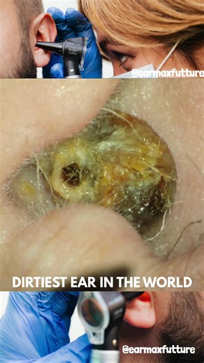 Effective Ear Wax Removal Techniques at Home