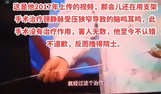 吉训明2017年上传的视频，那会儿还在用支架手术治疗颈静脉受压狭窄导致的脑鸣耳鸣，此手术没有治疗作用，害人无数，他至今不认错不道歉，反而撸得院士。
