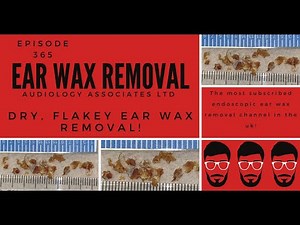 DRY, FLAKEY EAR WAX REMOVAL EP 365