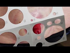 Stoma instructiefilmpje tweedelig ileostoma