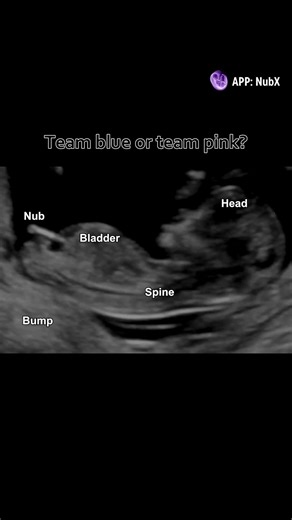 Understanding Gender Reveal Ultrasound Scans