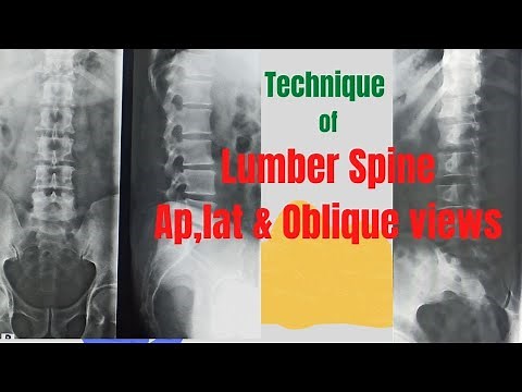 Technique of L Spine Ap , Lat & Oblique views (Ep-63) |X-ray lumber spine views