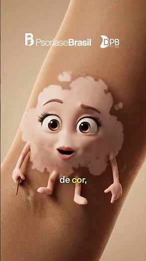 Vitiligo is a chronic, autoimmune condition that extends far beyond the skin.