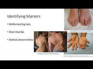 The disorder that turns your body to bone - Fibrodysplasia Ossificans Progressiva (FOP)