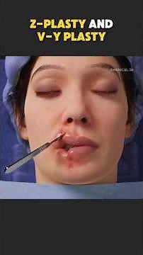 Z-Plasty & V-Y Plasty Explained | Advanced Facial Reconstruction Technique