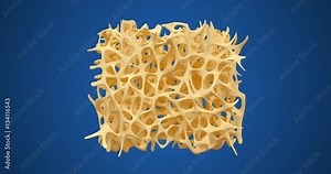 Developing of human bone osteoporosis spongy texture from normal to sick, time lapse 3d animation isolated ob blue background Stock Video