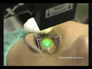 Corneal Collagen Cross-linking for keratoconus - Dr. Marco Abbondanza