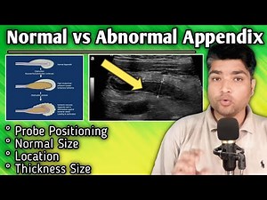 Appendicitis in Ultrasound, Appendix Probe Positioning | Appendix Inflammation in Ultrasound