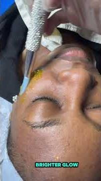 What is dermabrasion? #esthetician #dermabrasionfacail #dermabrasion