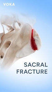 489K views · 1.7K reactions | Demystifying Sacral Fractures: Zone 1 ...