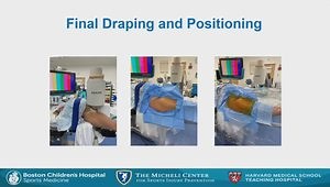 Basics of Hip Arthroscopy Setup and Access