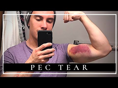 How I RECOVERED from Pec Tear Surgery in ONLY 4 MONTHS
