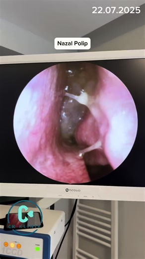 Understanding Nasal Polyps: Information and Insights