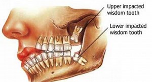 How Many Wisdom Teeth Do People Have? (INFOGRAPHIC) | Oralux Dental