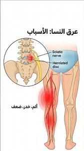 ألم يمتد من الظهر إلى الساق؟ قد يكون عِرق النسا!