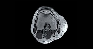 MRI膝関節またはMRI検査前十字靱帯(ACL)の断裂または捻挫を検出するためのAxial T2。