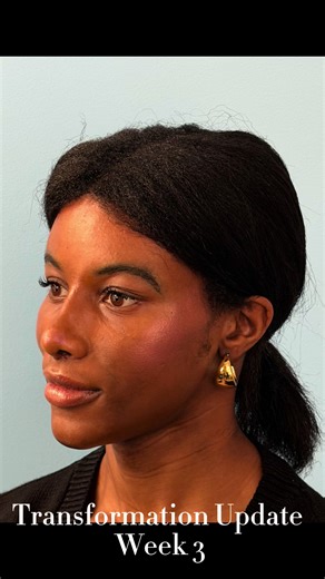 Facial Feminization Transformation Journey: Week 3 Insights