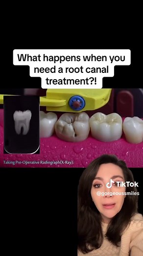 Understanding Root Canal Treatment: Process and Benefits