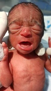 Please pray for baby 🙏🤲☝️ premature baby birth 🤔 #Premature #baby #reels | Global Nursing Profession