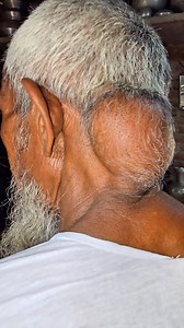 58K views · 349 reactions | Giant Lipoma | Dr Khaled's Tumour Helpline | Facebook