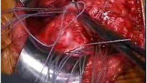 Open Rotator Cuff Repair of an Irreparable Tear