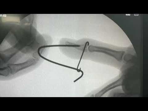 DELTA WIRE TECHNIQUE FOR MALLET FINGER