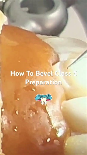 Class V Cavity Preparation Bevel Technique | Dental Bench Test & Operative Dentistry Tip