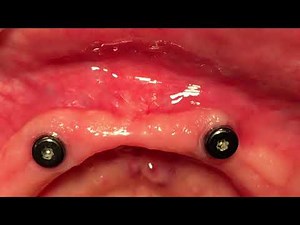Straumann : Temporally Mandibular overdenture retained by two Novaloc® abutments