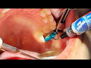 Inside a Tooth Filling 🦷 | Preparation and Bonding Steps