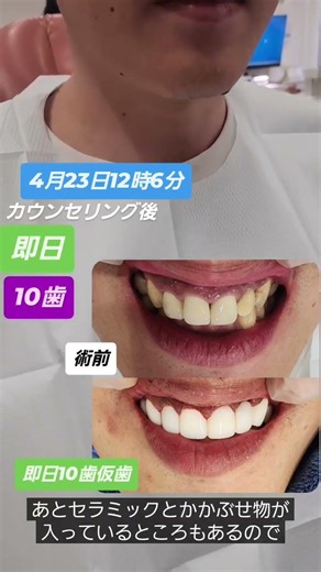 即日前歯の今井です。虫歯や欠損歯などでお悩みの方をカウンセリング後、即日仮歯で美しくしていきました。虫歯治療や抜歯も含めて10歯を仮歯にしていきました#セラミック#ダイヤモンド今井院長