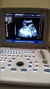 21 weeks baby movement | ultrasound