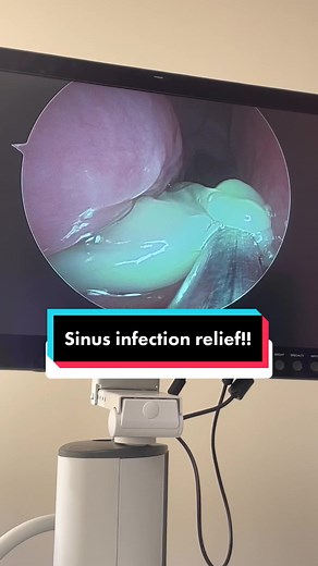 Sucking pus from an acute sinus infection provides immediatr relief! #ent #sinusrelief #booger #sinusinfection
