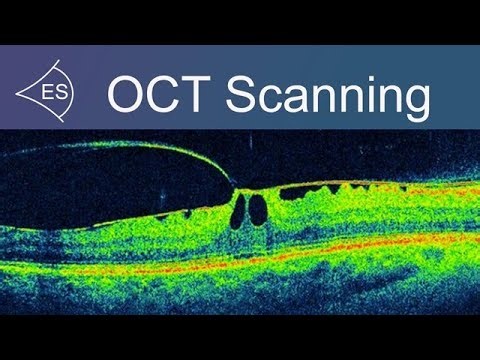 OCT Scanning: early detection of eye conditions (Optical Coherence Tomography)