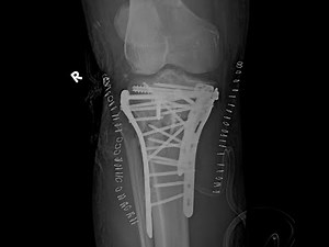 Three column classification of proximal tibia/tibial plateau fractures- explanation with examples.