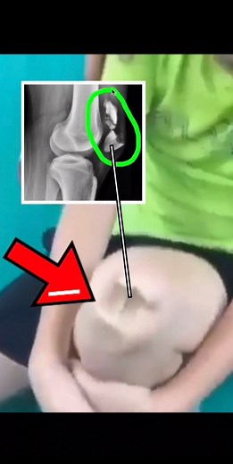 3.9K views · 37 reactions | 喙Diagnosis: Traumatic Comminuted...