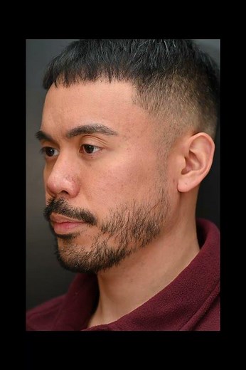 Restoration Rhinoplasty with Rib Cartilage and DCF - Revision Male Nose Job #nosejob #rhinoplasty