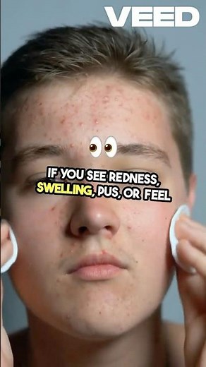 Boils, Abscesses & Fistulas – Causes, Symptoms, Modern Treatment #shorts