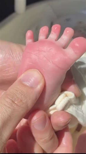 Método Pés De Rica | Podologia Premium 🦶 on Instagram: "VOCÊ SABIA? 👉 Esse movimento é conhecido como reflexo de Babinski ou reflexo plantar. Este reflexo, normal em bebês, provoca a extensão do dedão do pé e a abertura dos outros dedos em leque, como resposta ao estímulo tátil na sola do pé. 👉 O quê: Um reflexo primitivo do sistema nervoso que é normal em bebês e geralmente desaparece com o crescimento. 👉Importância: É importante verificar a presença e o desaparecimento do reflexo de Babins