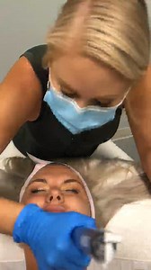 Microneedling with SkinPen
