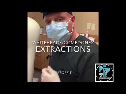 Whiteheads and comedones for days. Extractions. Cyst pops. Big squeeze. Juicy pops. MrPopZit.