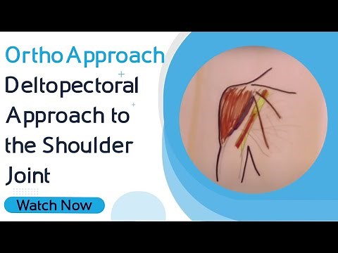 OrthoApproach - Deltopectoral Approach to the Shoulder Joint | Orthopaedic Academy