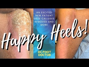 Happy Heels: Heel Callus Removal and Toenail Trimming Equal an Amazing Transformation (New Patient)