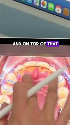 Dangers of Permanent Retainers…and How We Can Fix These Problems with Invisalign.