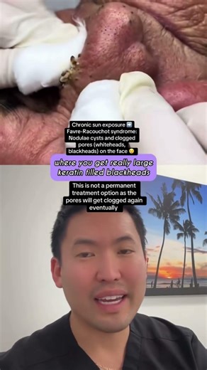 Why You Need to Wear Sunscreen Every Day