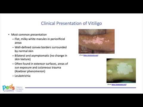 Approach to Pediatric Vitiligo Video