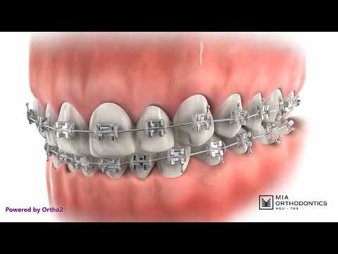 Parts of Braces Explained: Brackets, Wires, and Elastic Ties