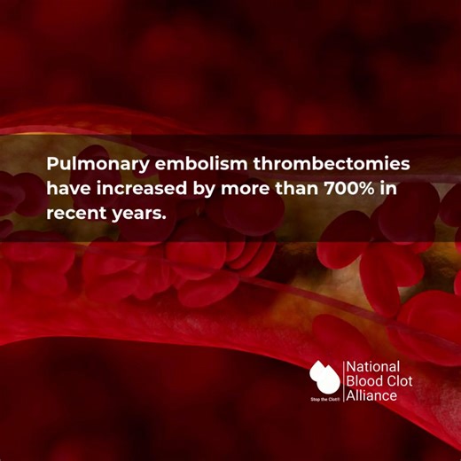 New research shows how quickly blood clot treatment is evolving. A national study found that thrombectomies, or procedures to remove pulmonary emboli from the lungs, have increased more than 700% since 2017. Experts say this sharp rise reflects major improvements in technology that now make these minimally invasive treatments safer and more effective than they were a decade ago. Most of these procedures are now done in outpatient hospital settings, reflecting how treatment for blood clots is bec
