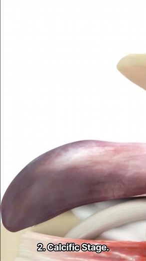Unveiling The Stages Of Calcific Tendinitis Symptoms
