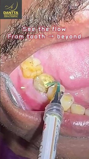 Dental Abscess: Drainage & Healing
